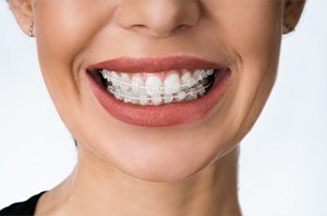 Woman wearing clear braces